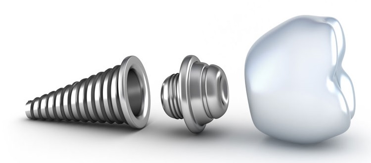 ایمپلنت طالقانی کرج