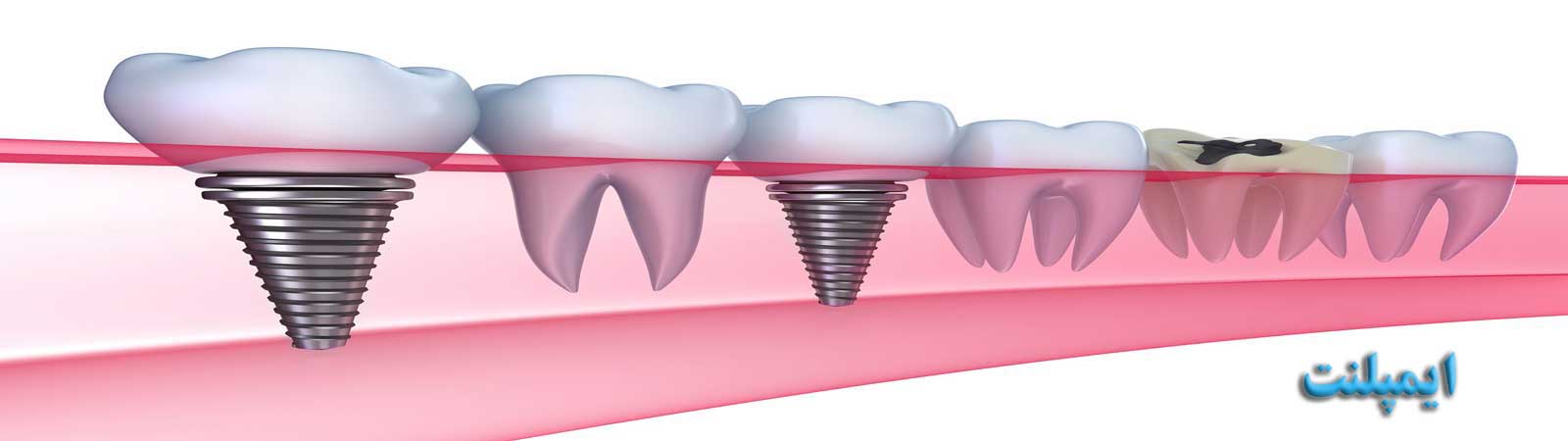 ایمپلنت کرج